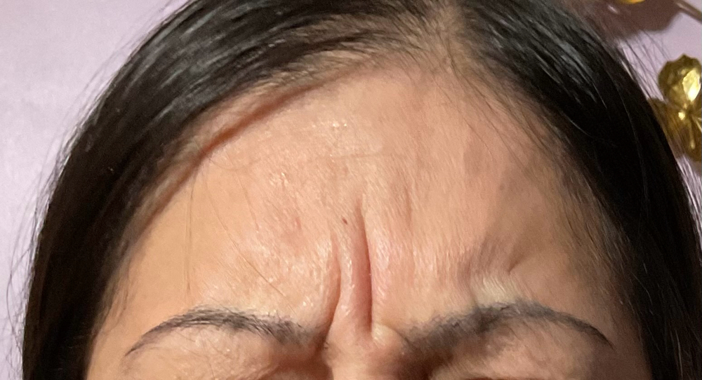 Cosmetic Tox By Area at Unveiled Beauty Aesthetic Studio in Converse, TX