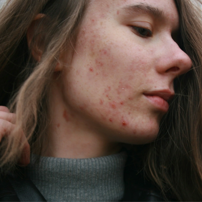 Acne Treatment Facial