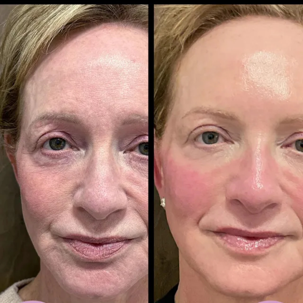 RF Pro Skin Tightening at Haven Skincare & Aesthetics in Boerne, TX