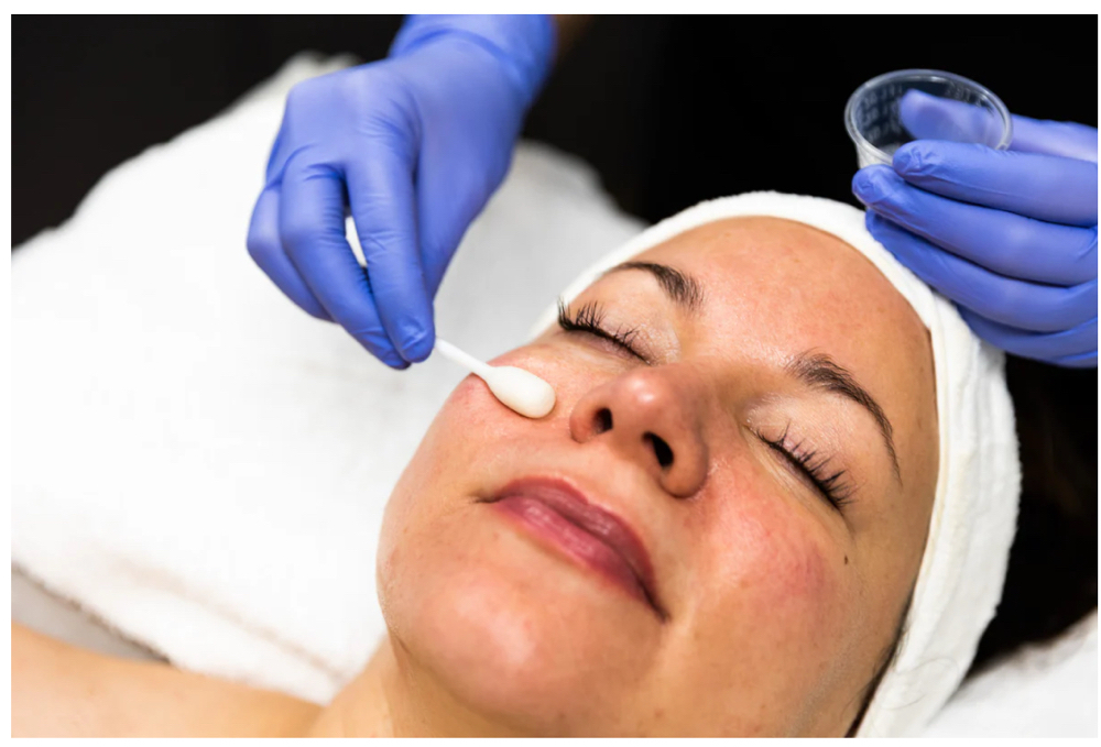 Chemical Peel