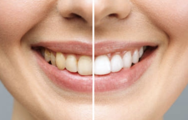 Teeth Whitening