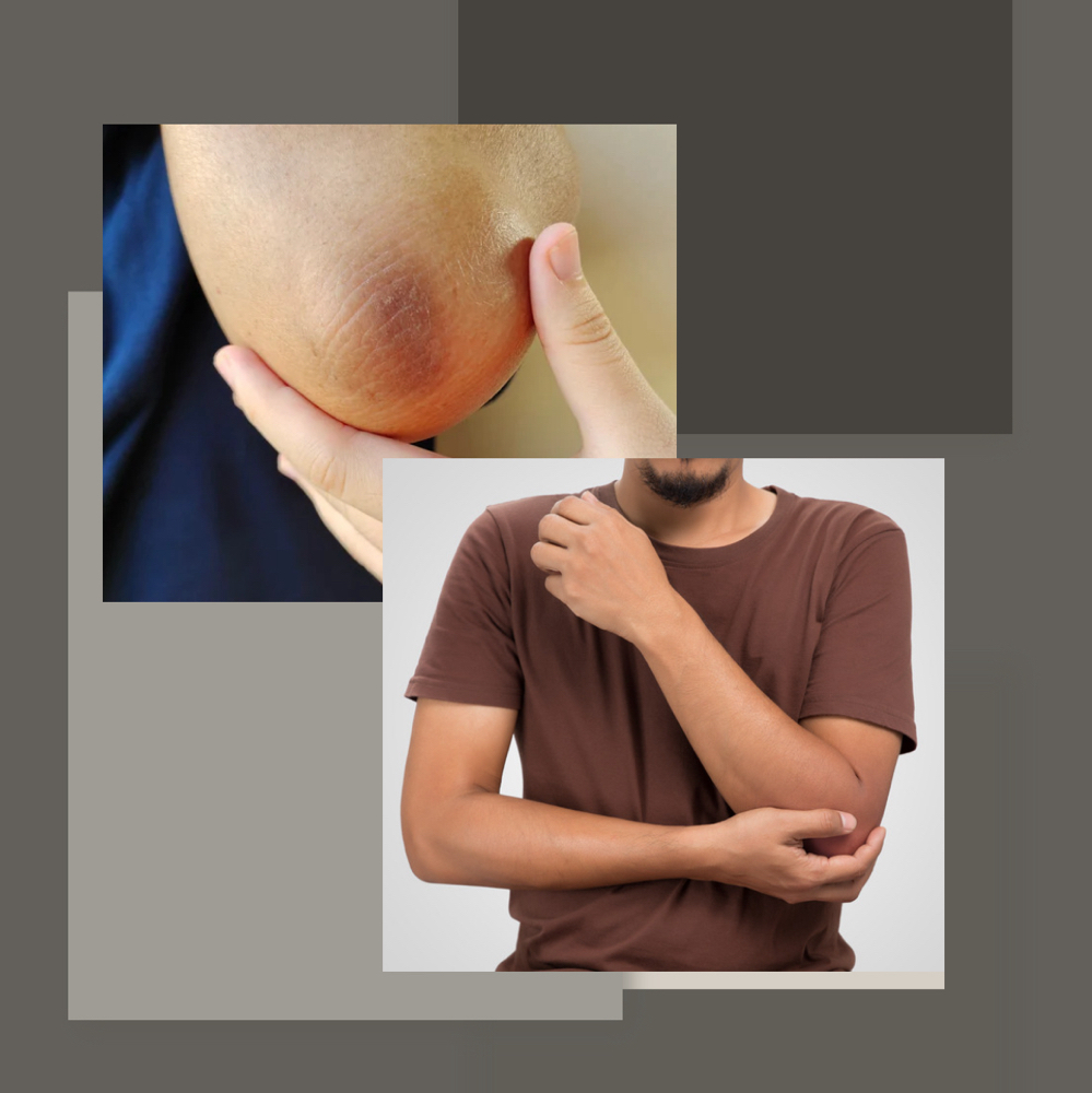 Elbows Lightening (1 Treatment)