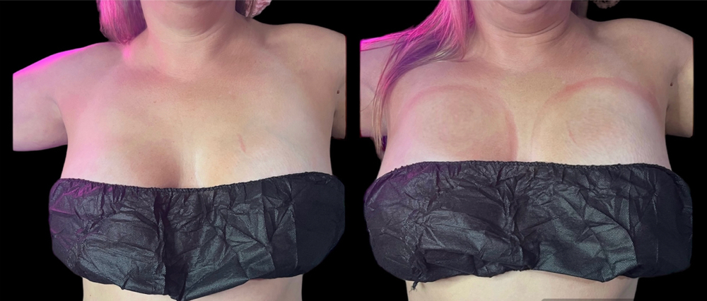 Non Surgical Breast Lift
