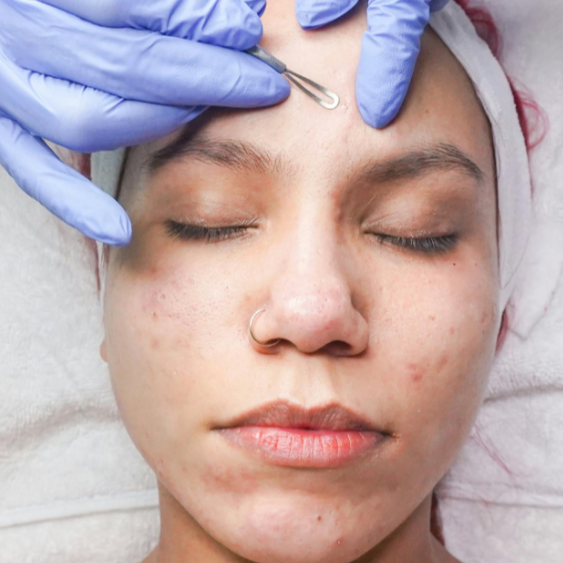 Acne Facial at Skin by Lily in Las Vegas, NV