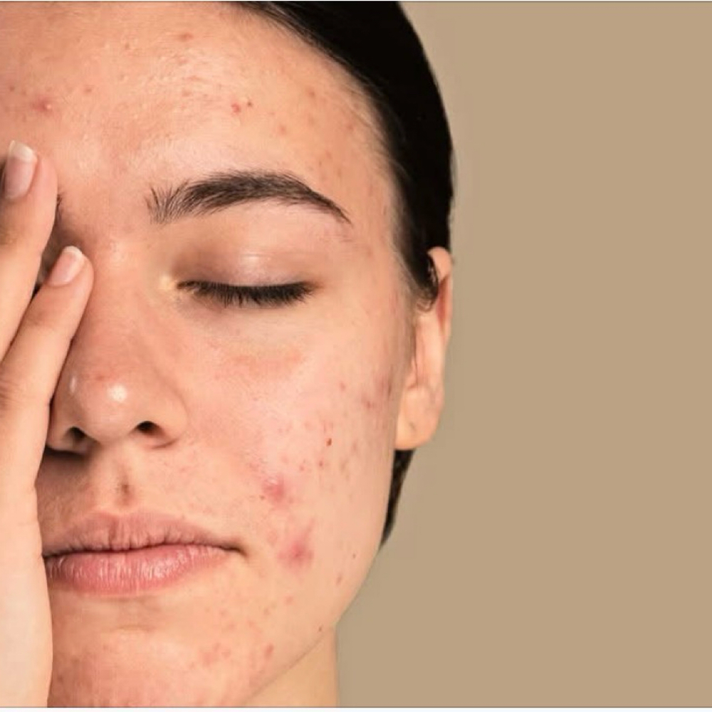 The Acne at Lush MedSpa & IV Lounge in Middlesboro, KY