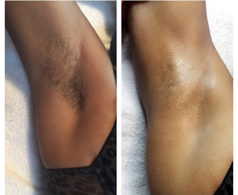Underarm