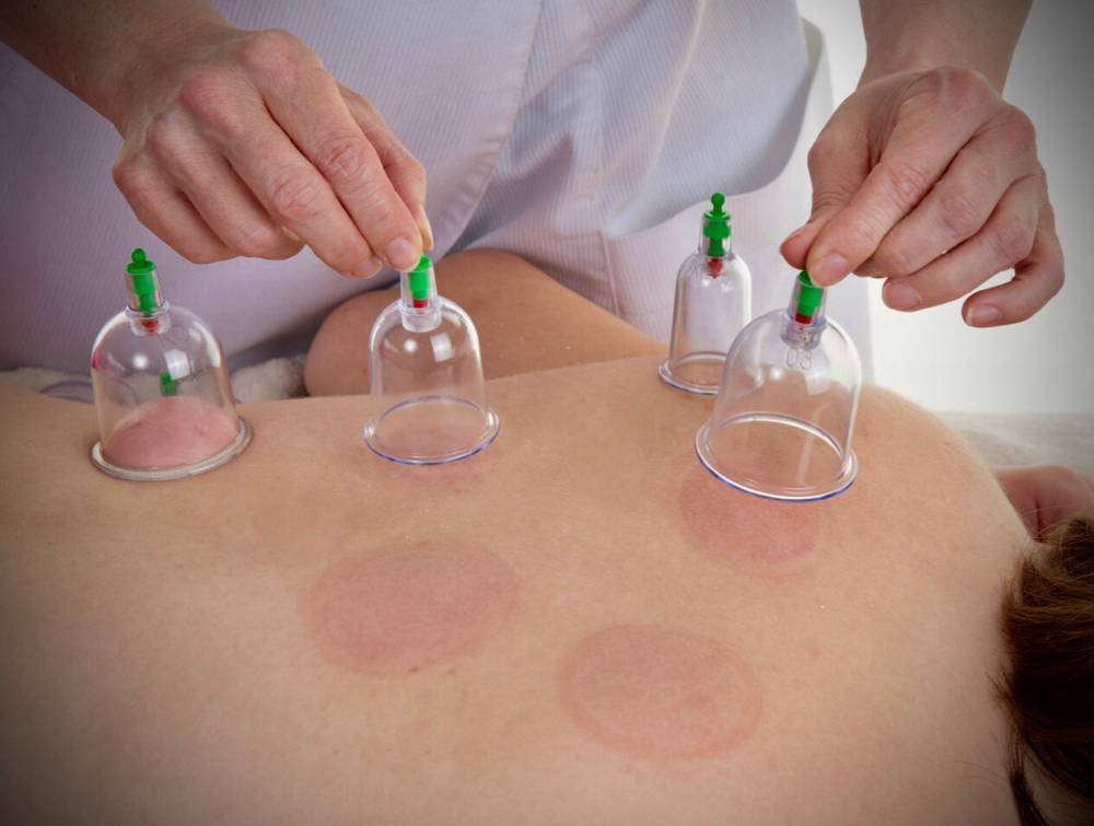 Cupping