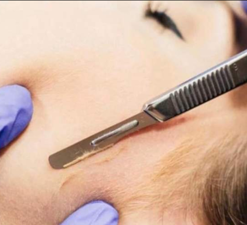 Dermaplane Facial Treatment