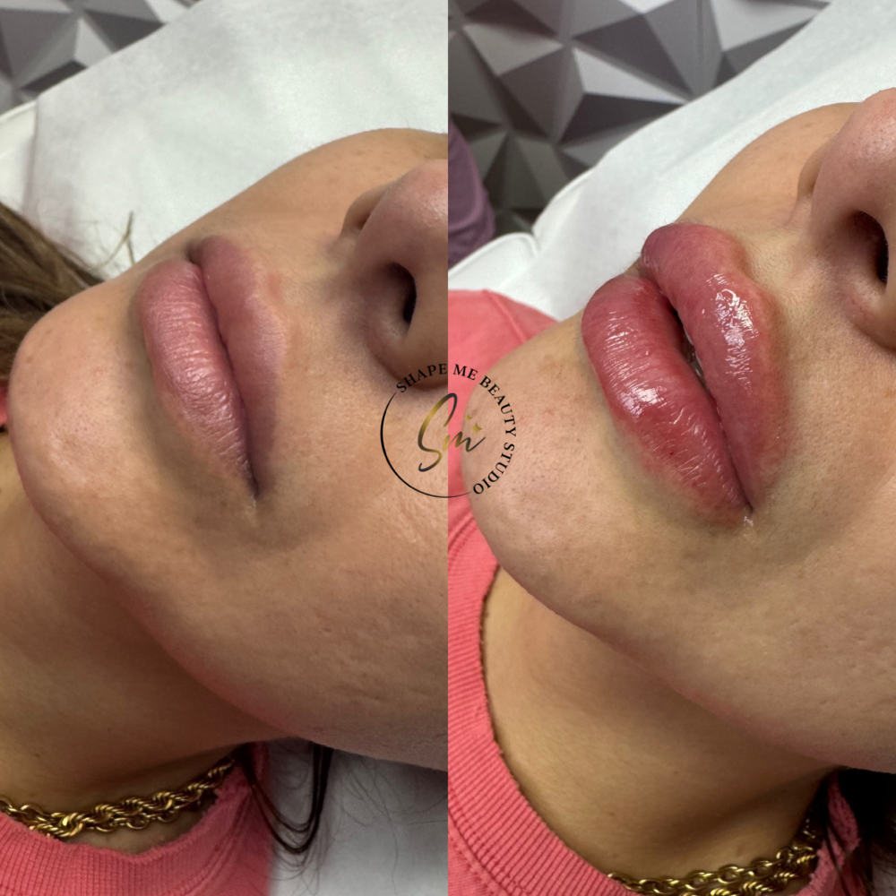 Lip Filler 1ml lips at Shape Me Beauty Studio in Midland, TX