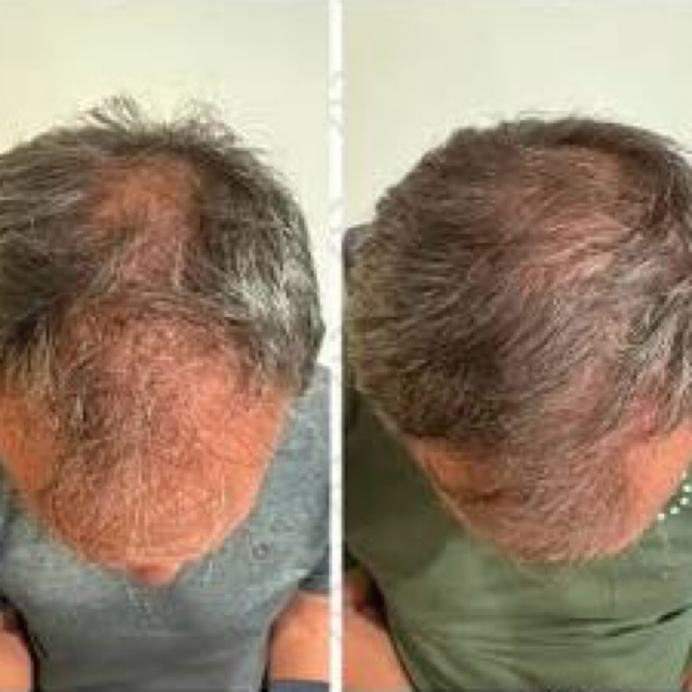 ✨ Vitti-Pure Hair Restoration at Cedar & Sage Aesthetics & Wellness in Hiawassee, GA