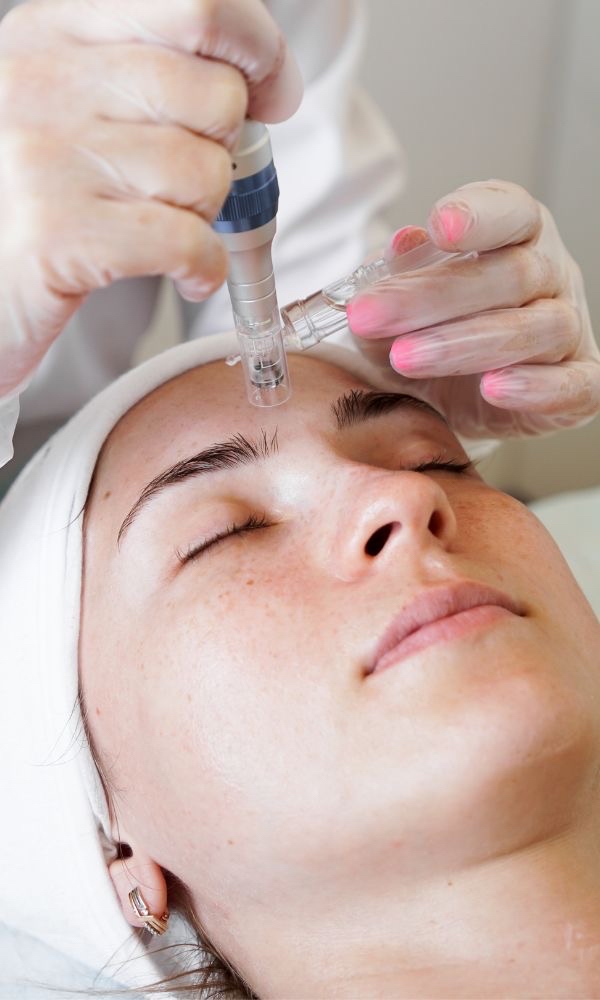 Microneedling
