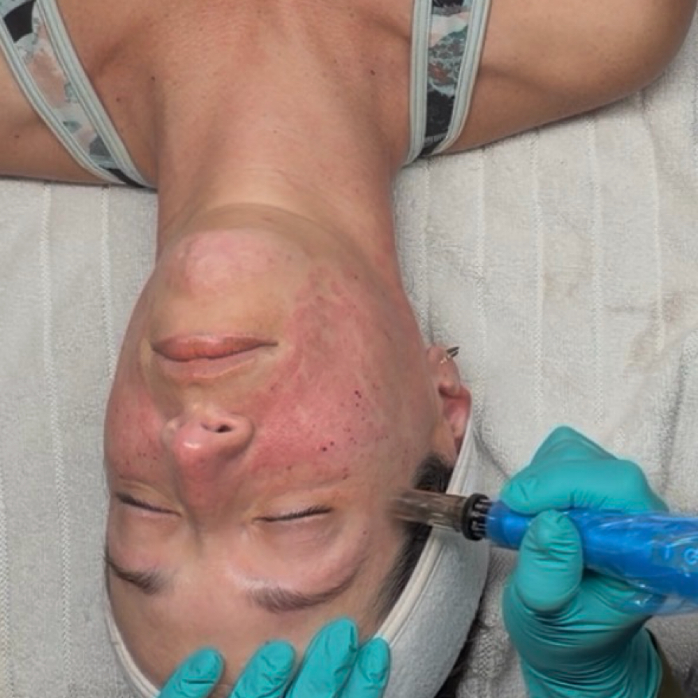 Rejuvapen Microneedlin Exosome at One Skin by Mabel in Palmetto Bay, FL