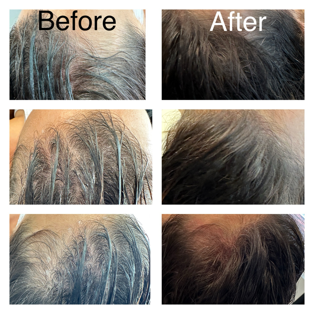 Scalp Micro-Pigmentation