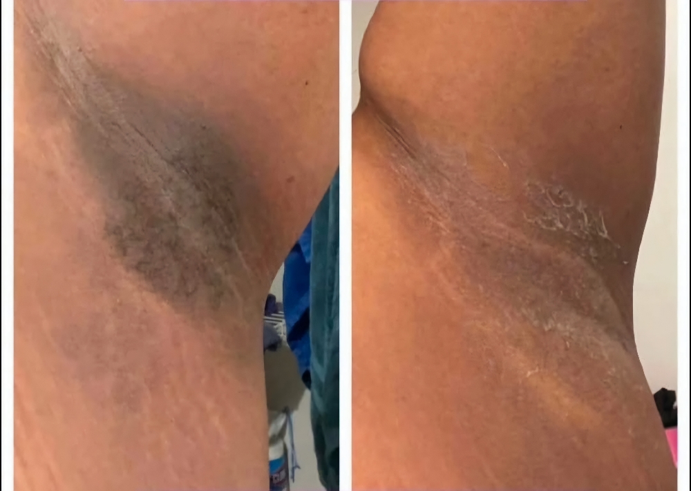 Intimate Lightening Treatments