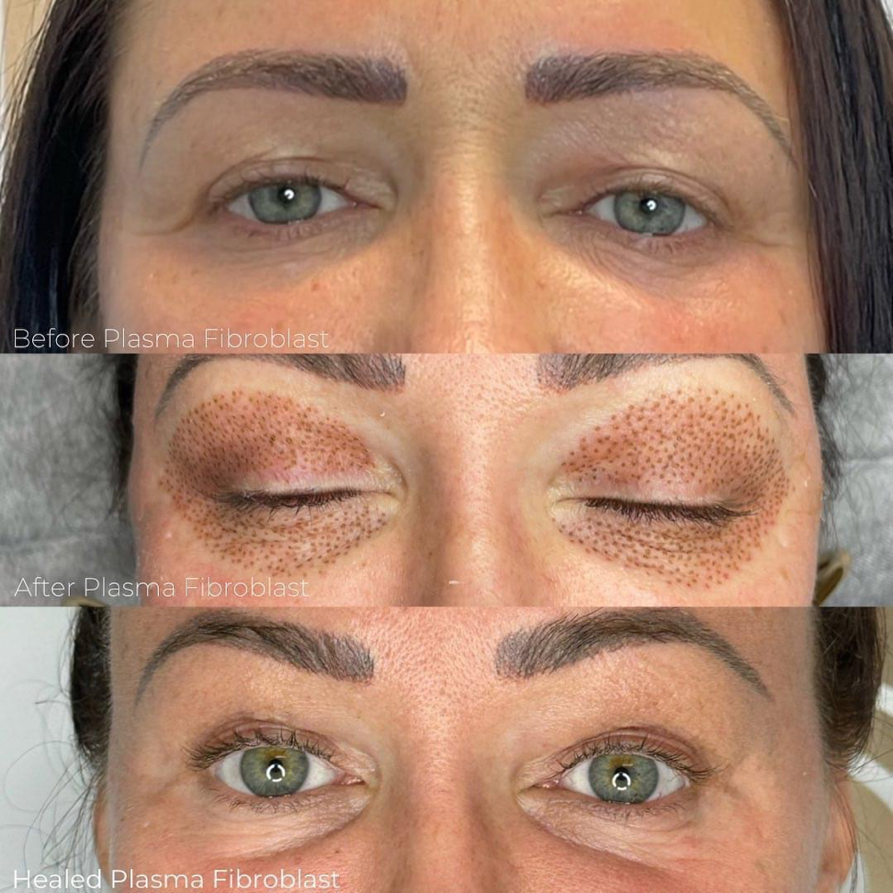 PLASMA FIBROBLAST SKIN TIGHTENING