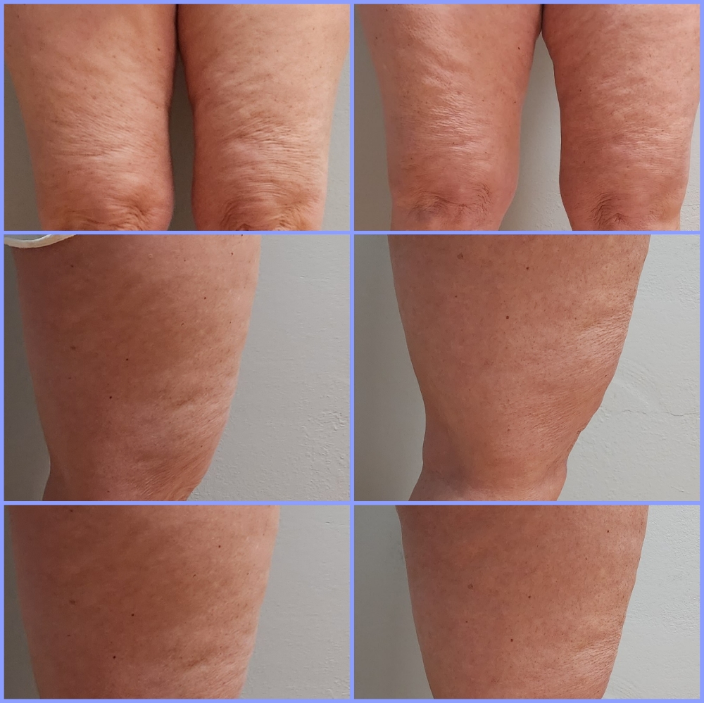 LipoSculpt