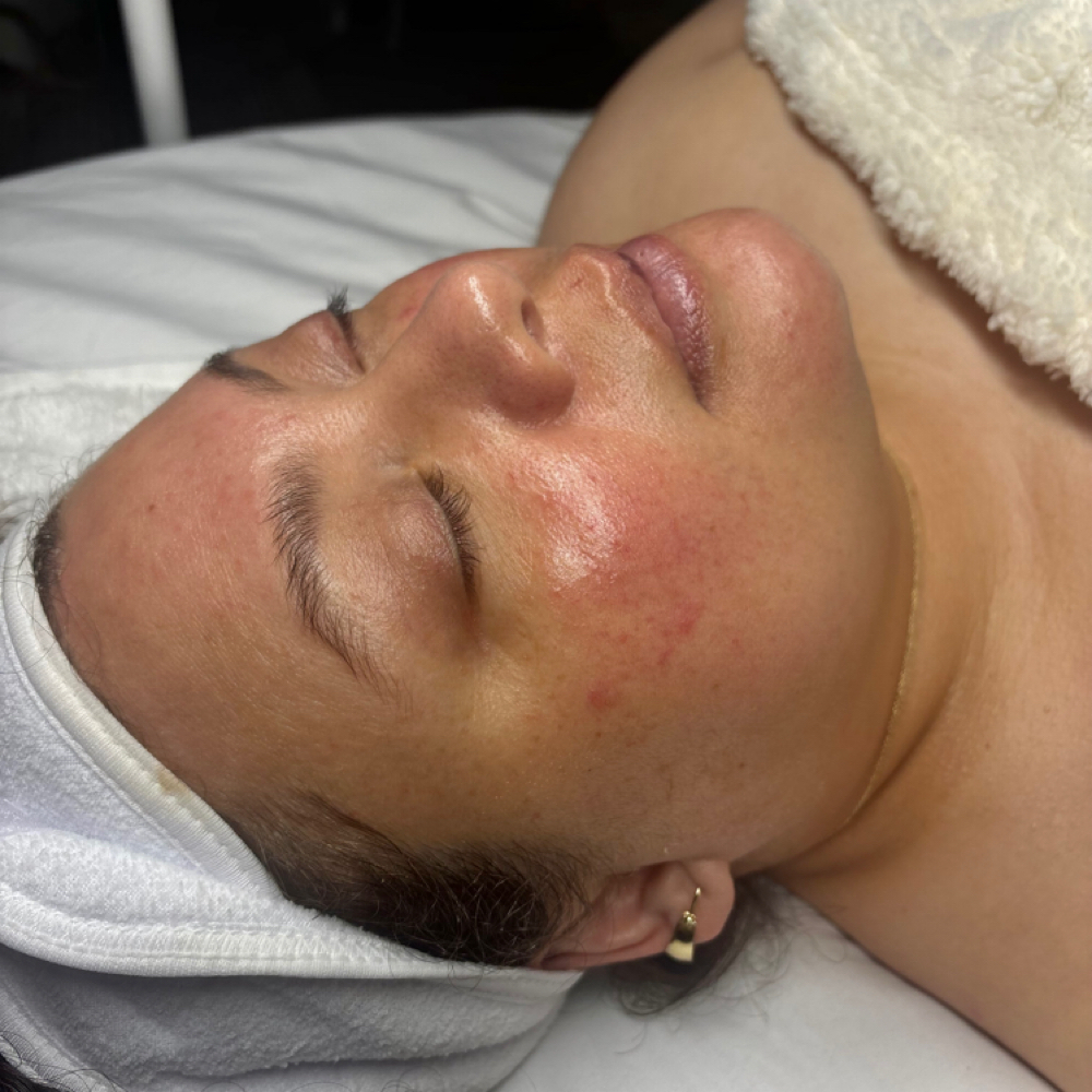Tailored Tide Facial at Pearly Derm in Sun valley, CA
