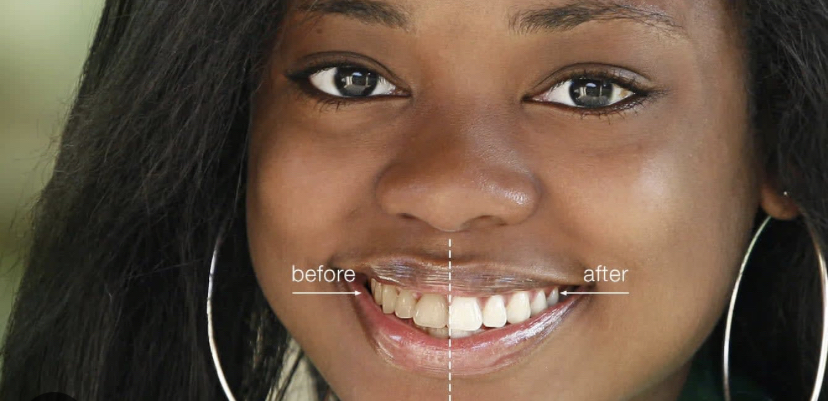 Youth Wow Teeth Whitening