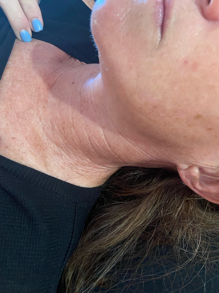 Skin Tightening Face/Neck