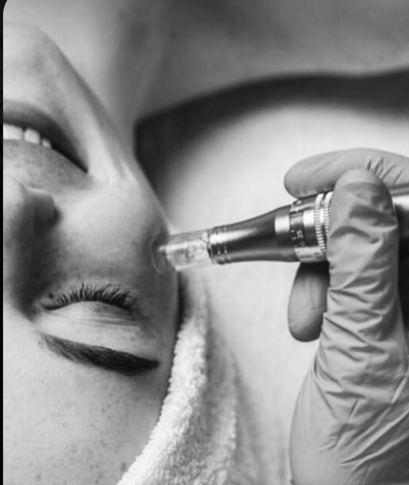 Microneedling