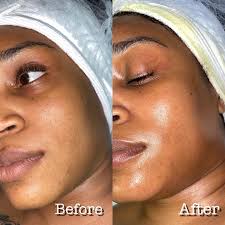 Full Face Dermaplanning
