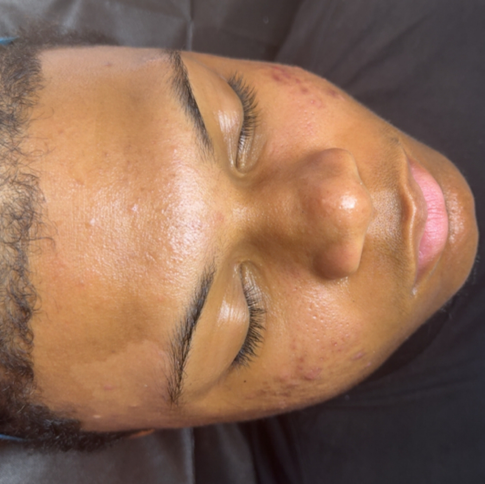 Acne Treatment Facial - Home at Bodied By Takis in Ridgeland, MS