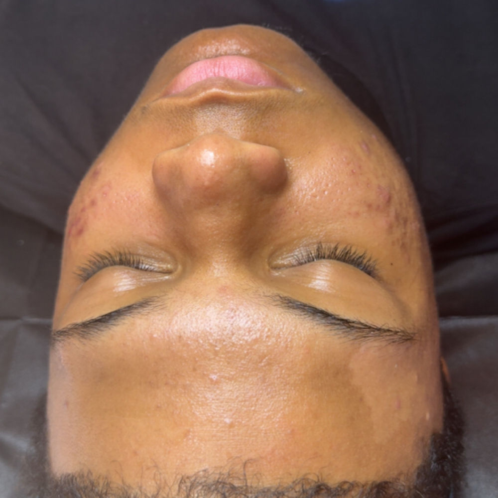 Acne Treatment Facial - Home at Bodied By Takis in Ridgeland, MS