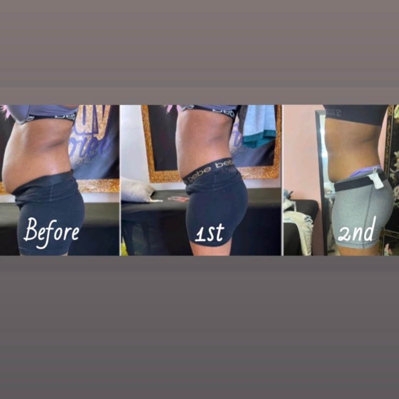 Laser Lipo at Cozy Braids in SOUTHAVEN, MS