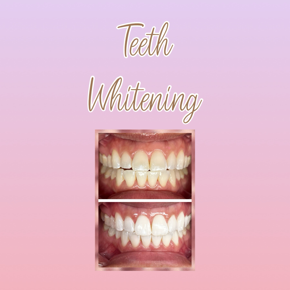 Teeth Whitening (Dental Grade)