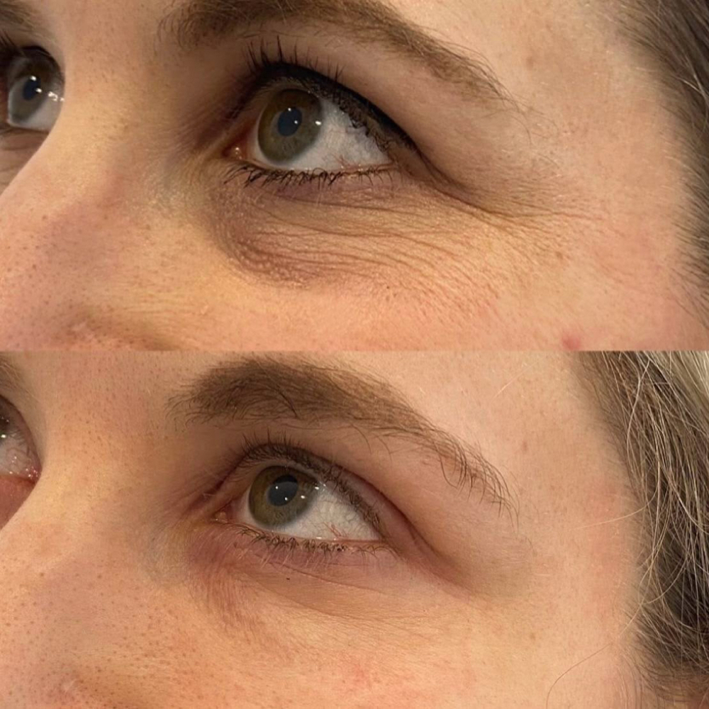 Dermalift Undereye Treatment at Bare Esthetics Medical Spa LLC in Idabel, OK
