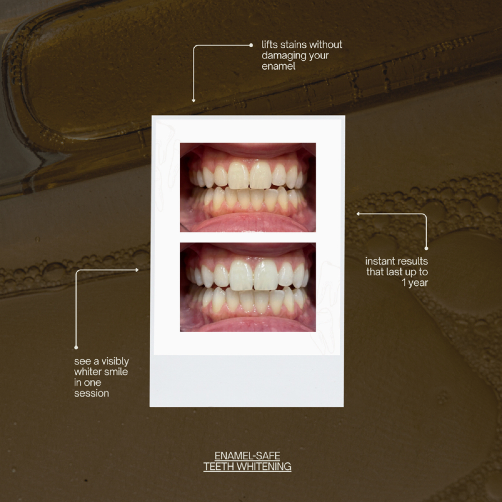 White Teeth - On Wheels