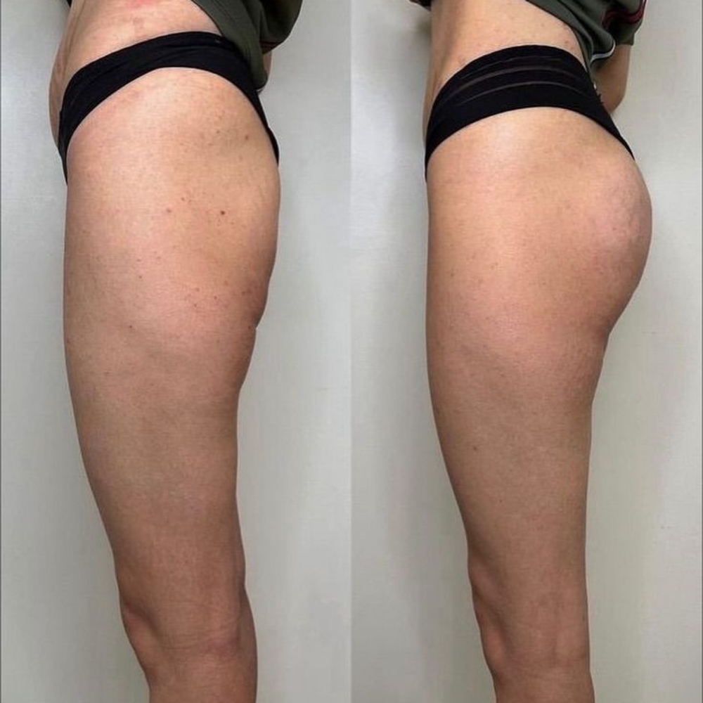 Non-invasive Butt Lift at Salon Bliss.LLC in Highland, IN