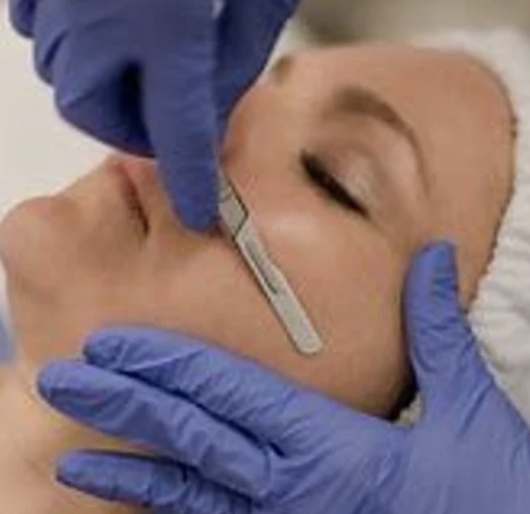 Dermaplaning