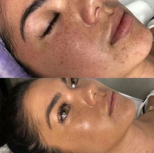 Microneedling