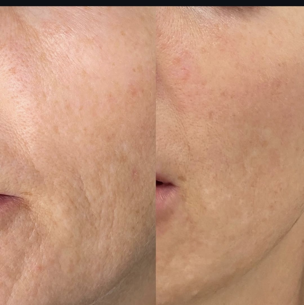 Microchanneling/ Microneedling