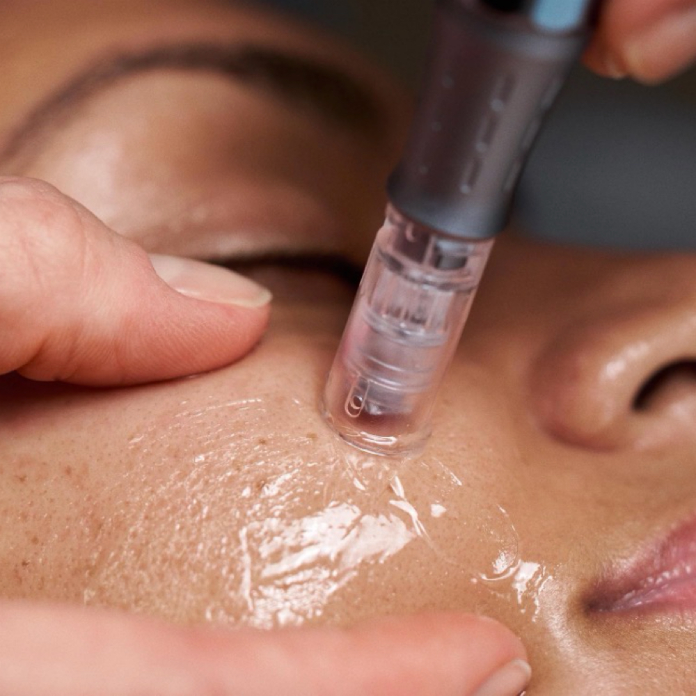 Nano Needle Infusion at Alpine Glow Aesthetics, LLC in Colorado Springs, CO