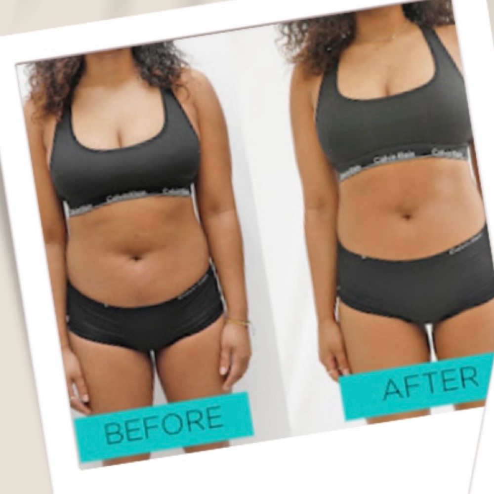 Body Contouring at Jubee Boutique MedSpa in Annapolis, MD