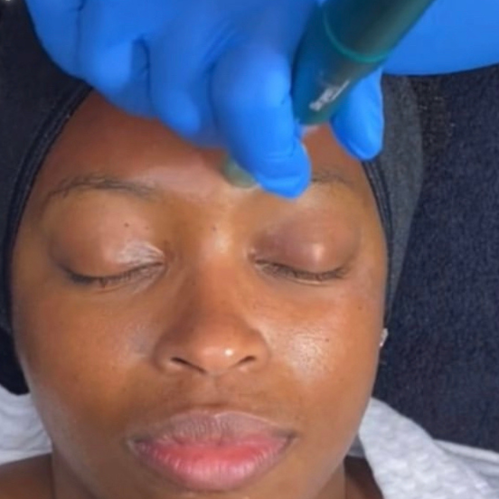 Holistic Microneedling at Vegan Luxe Esthetics in Houston, TX