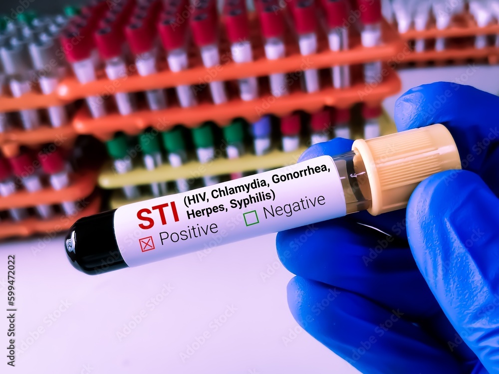 SYPHILIS RPR W/REFLEX
