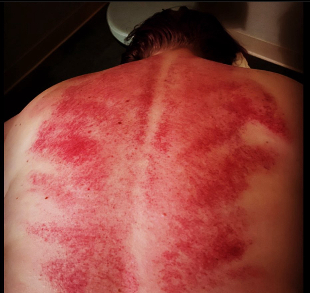 Gua Sha Treatment