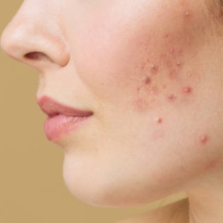 Acne Bootcamp (New Client) at SoLuna Aesthetics in Scottsdale, AZ