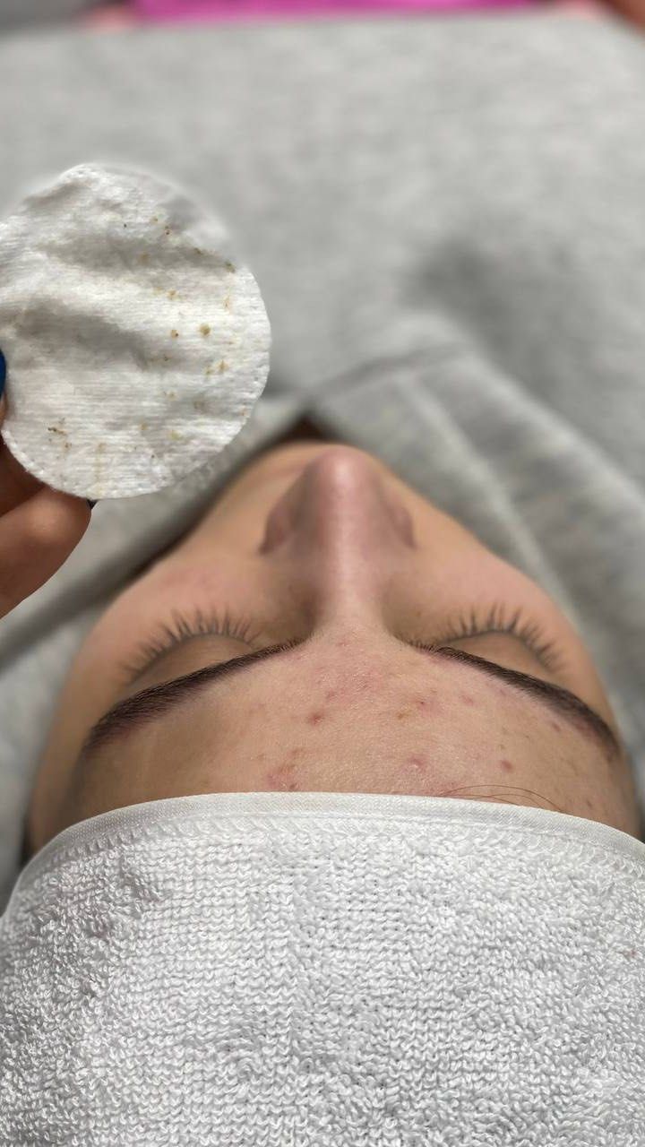 Clear Bloom Acne Facial