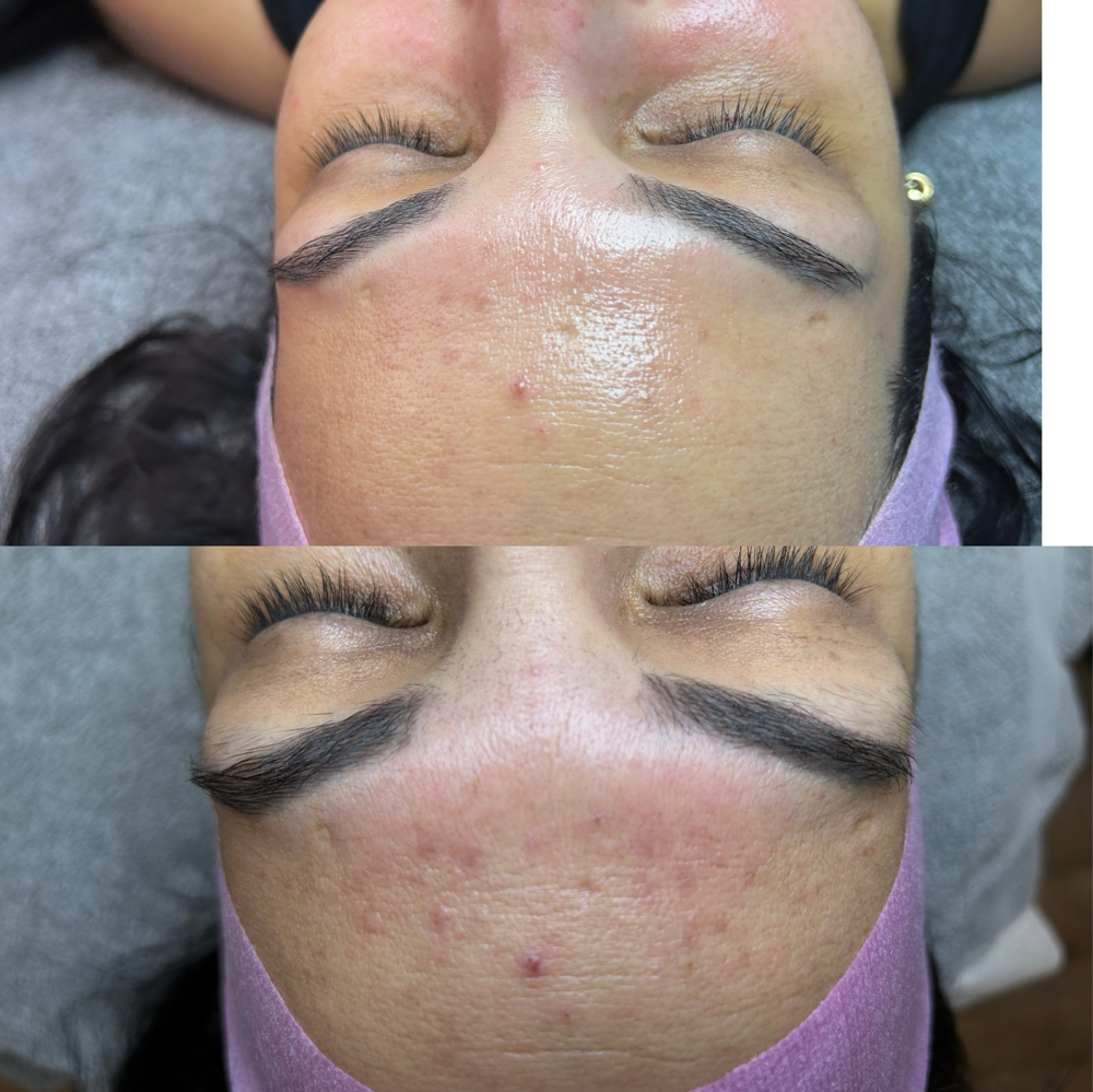 Carboxy Therapy/ Carboxyterapia