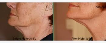 Neck Or Hands Collagen Induction