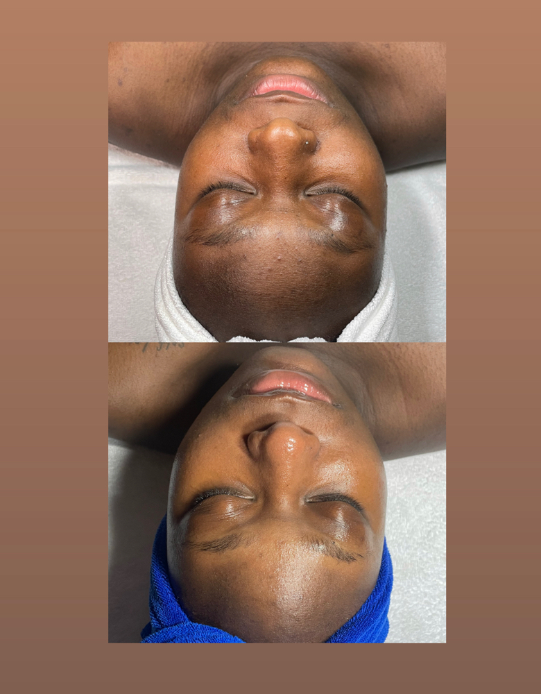 Acne Boot Camp