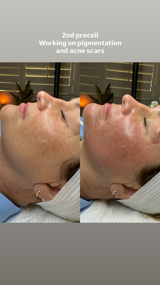 Microchanneling Buy 3 get 25% off