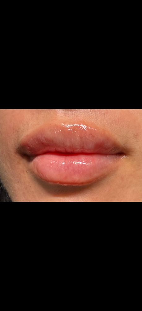 Lip filler