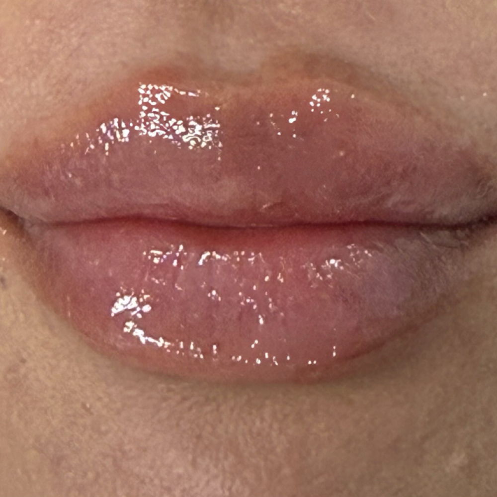 Lip Filler at Nueva Vida Medspa in Audubon, NJ