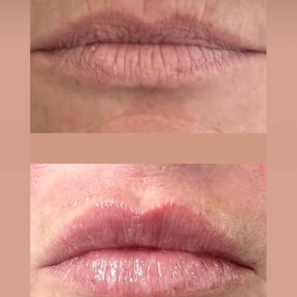 Lip Filler