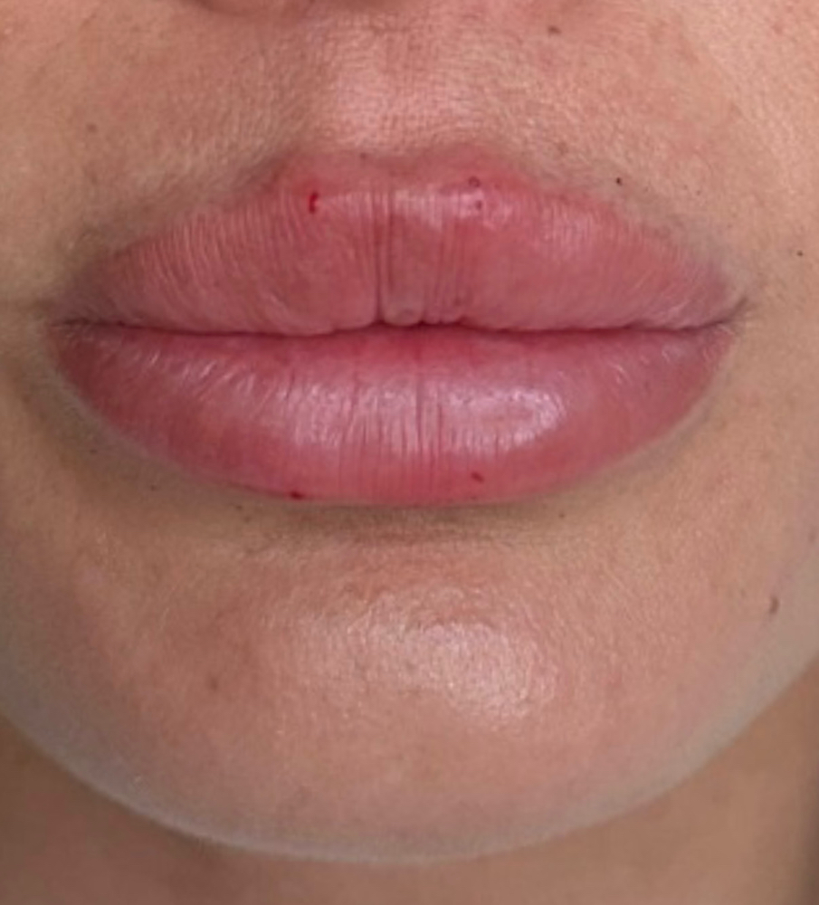 Consultation: Lip filler